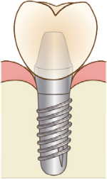 インプラント