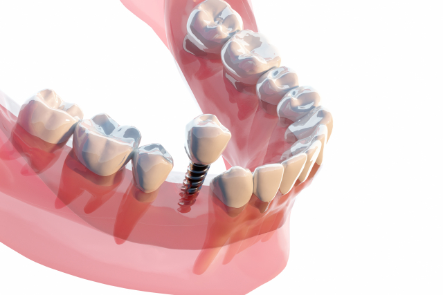 インプラント治療とは